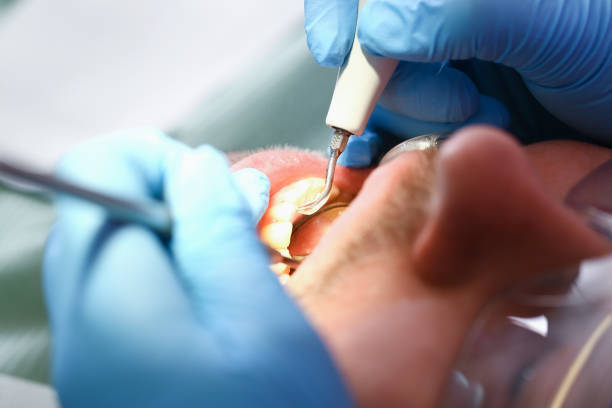 Best Emergency Tooth Extraction in Reidville, SC