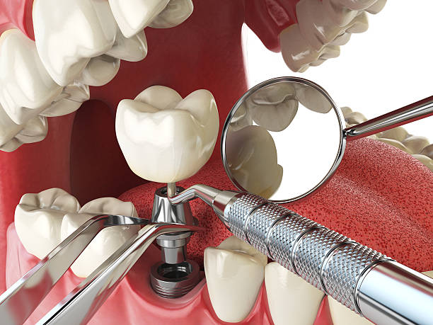 Best Emergency Tooth Extraction in Reidville, SC